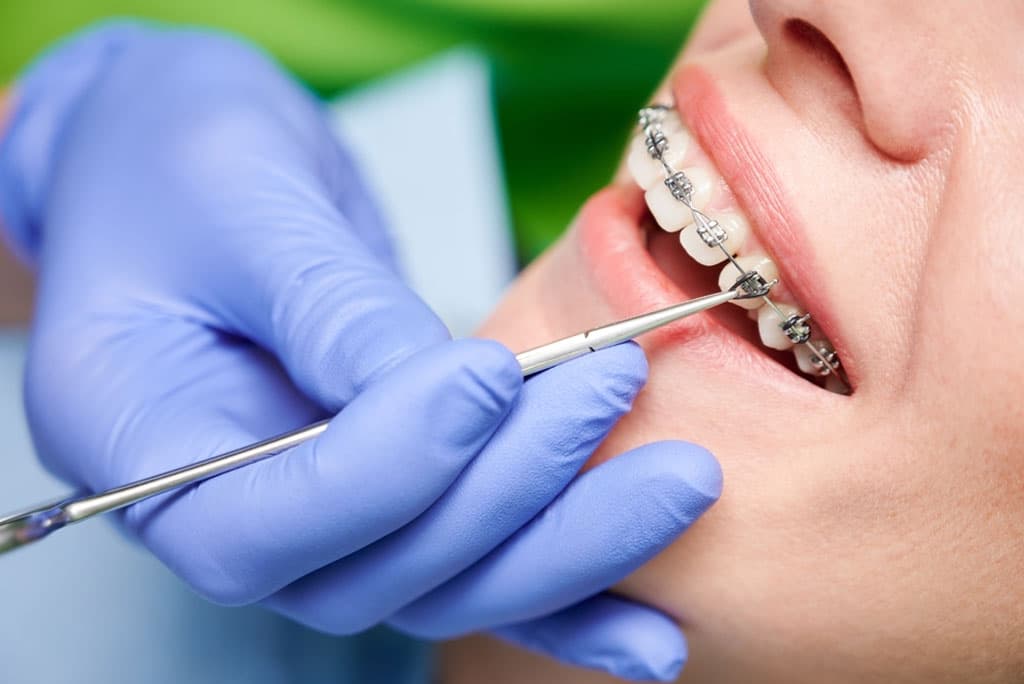 Orthodontic Treatment
