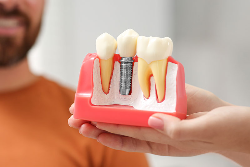 dental implant 5050