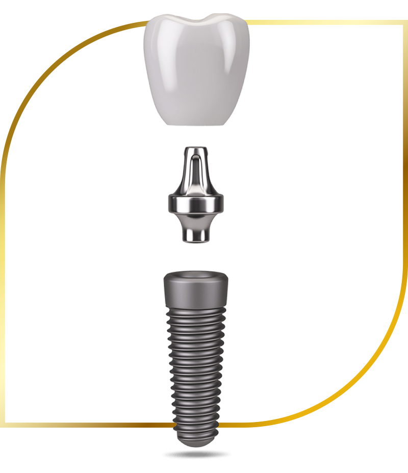 3 parts to dental implant graphic