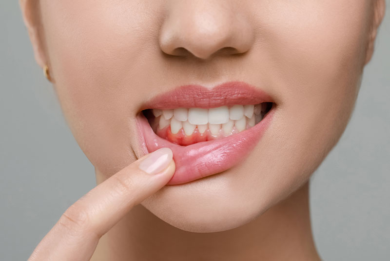 periodontal dental patient showing redness