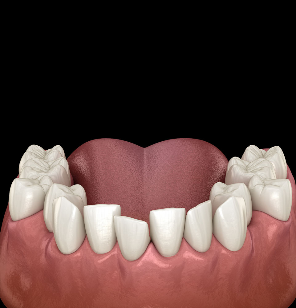 misaligned-teeth