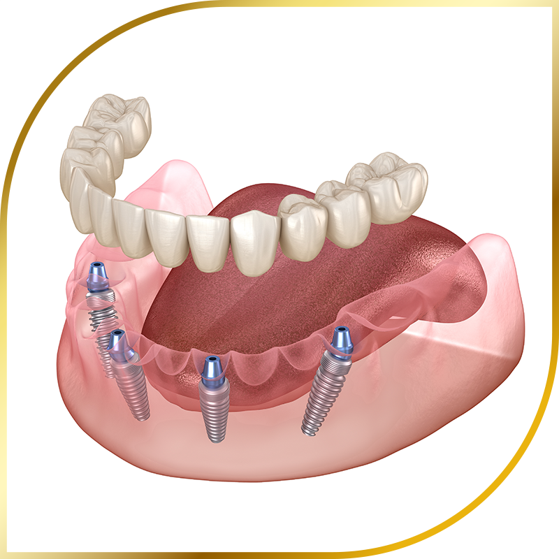 AO4 Dental implants