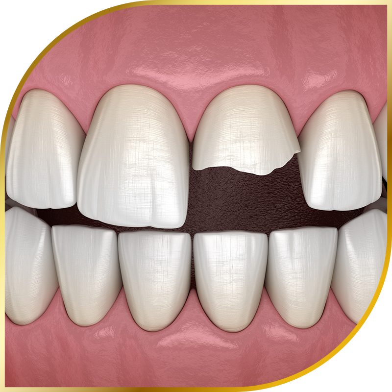 Cracked tooth