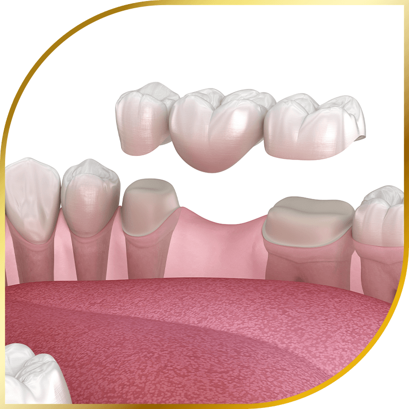 Dental Bridges