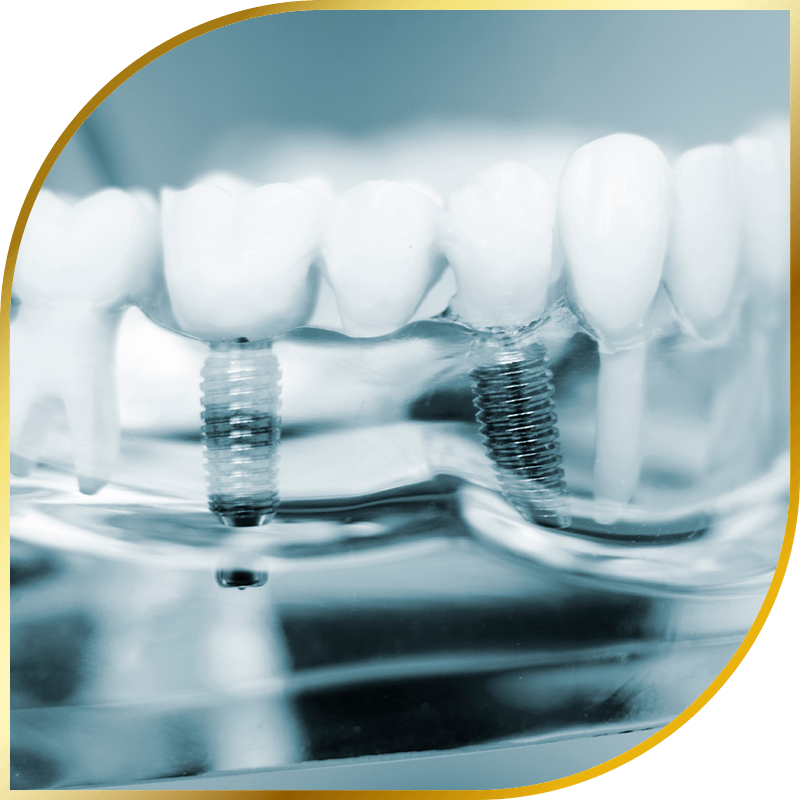 Dental Bridge