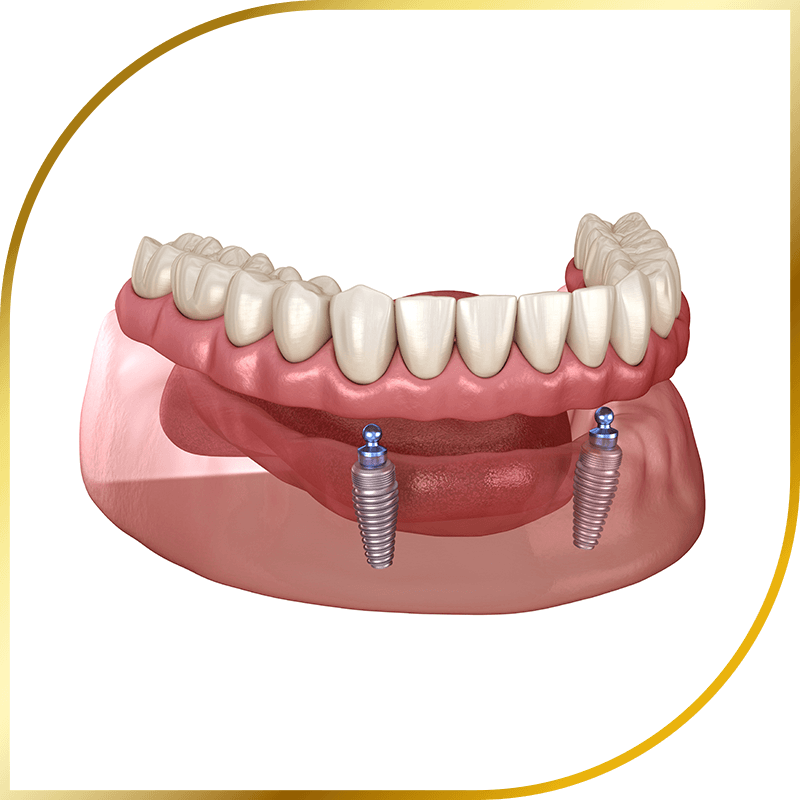 Dental implants