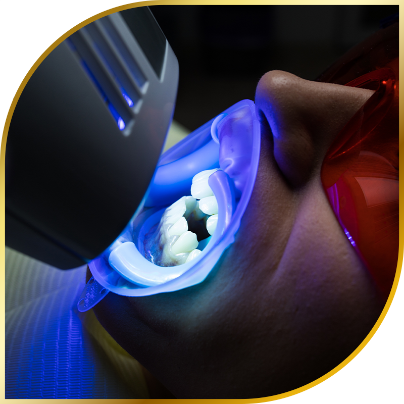 teeth whitening