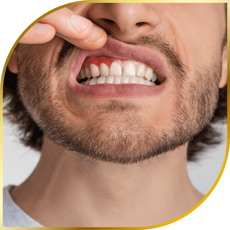 Gum Disease