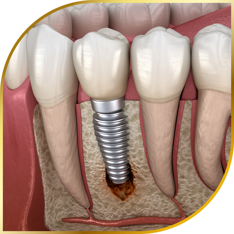Peri-Implantitis